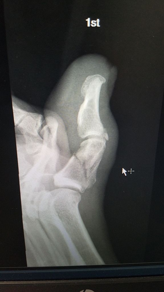 Injury from Real Estate Photography